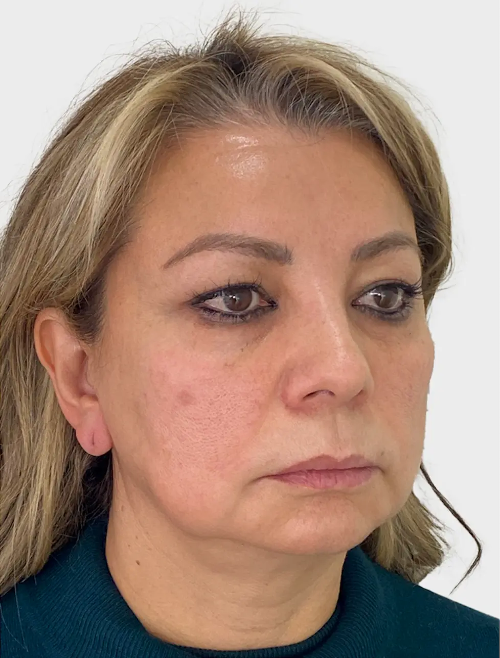 Resultado 1 - Antes