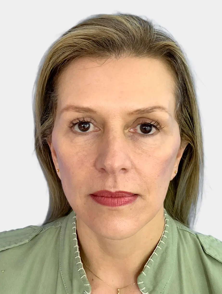 Antes - Restauración volumen facial