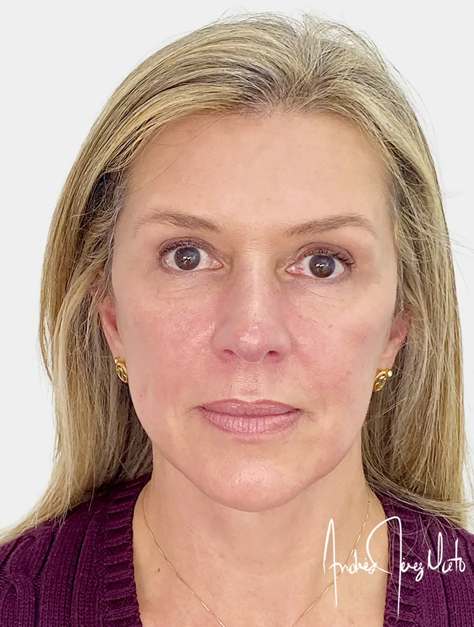 Después - Restauración volumen facial