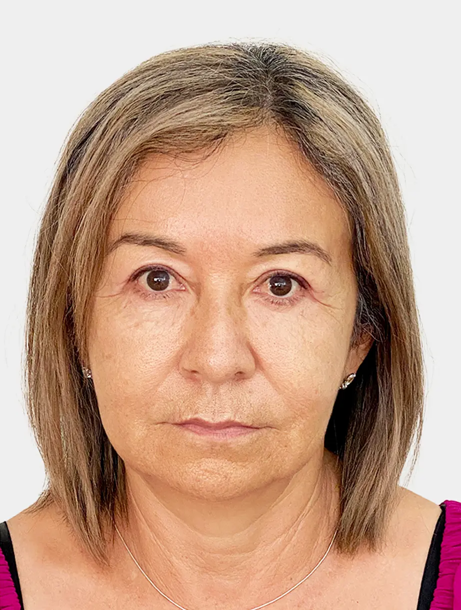 Resultado 1 - Antes
