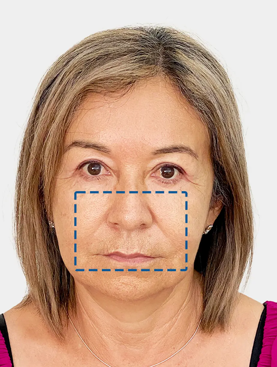 Resultado 2 - Antes