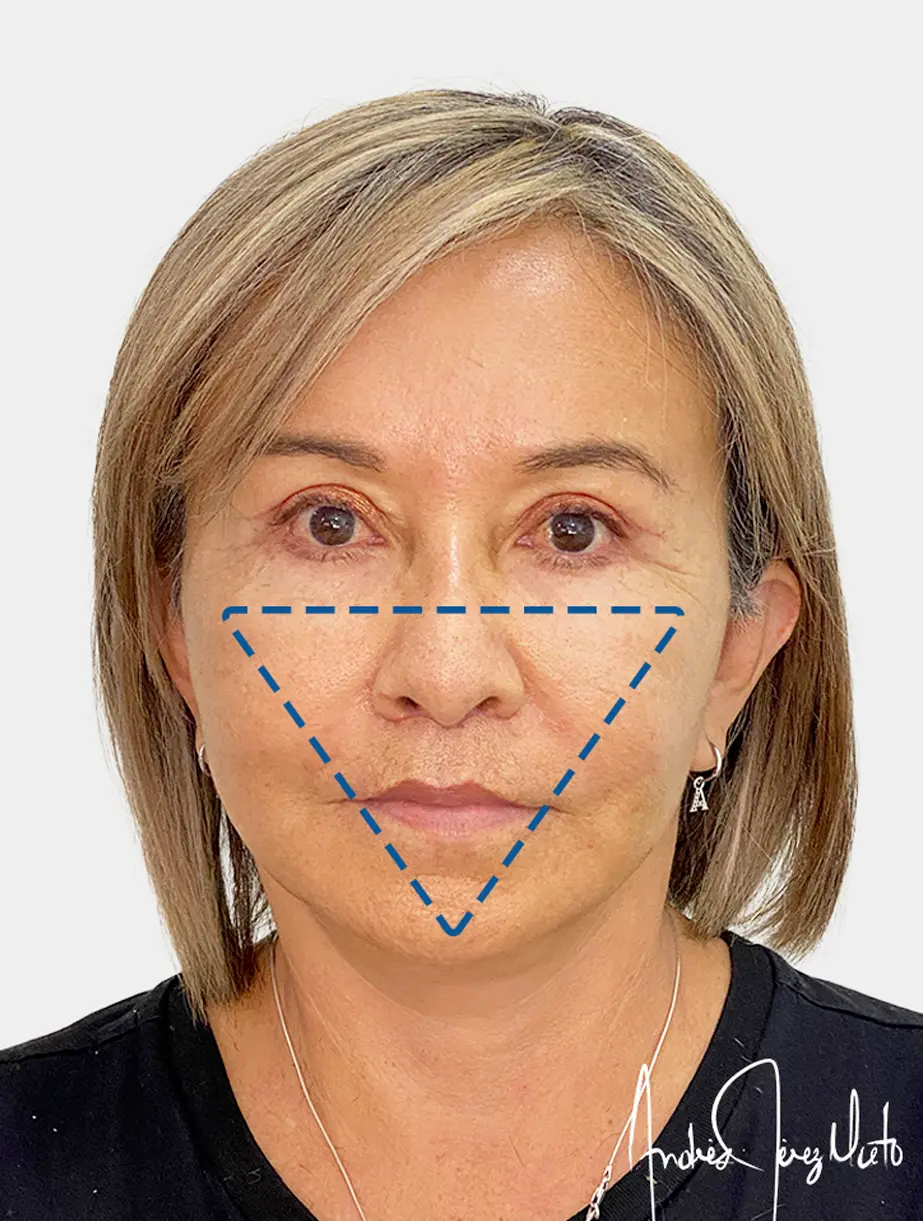 Resultado 2 - Después
