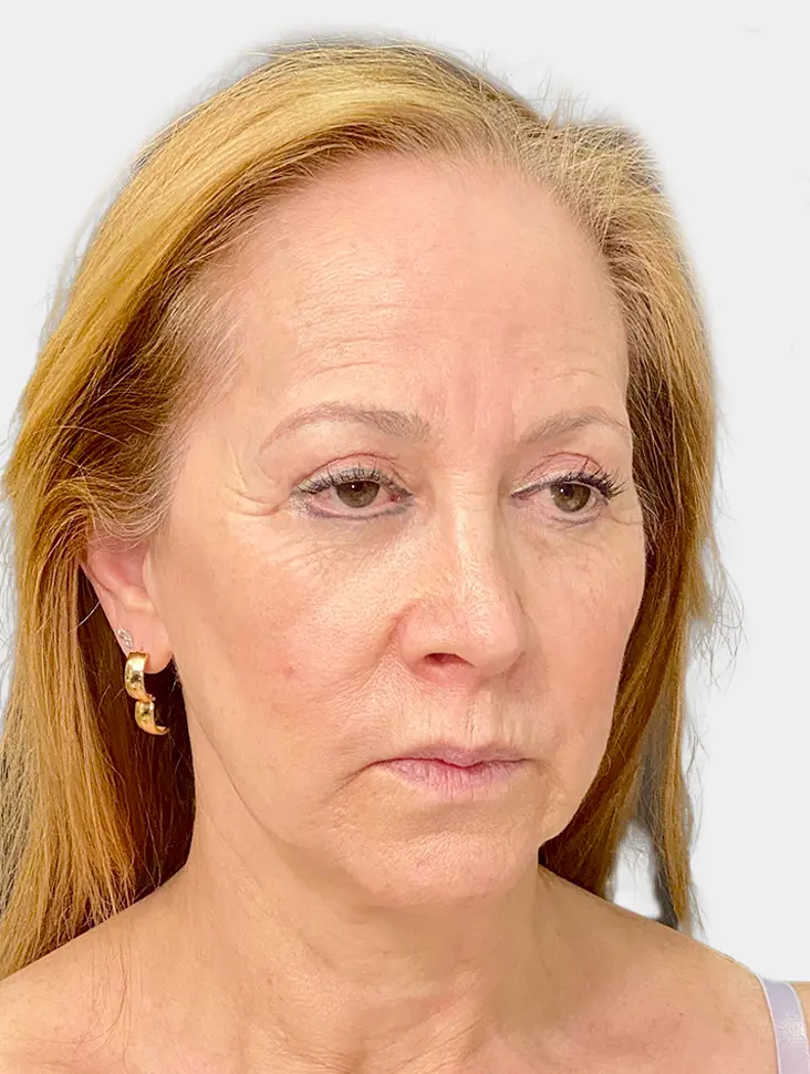 Resultado 2 - Antes