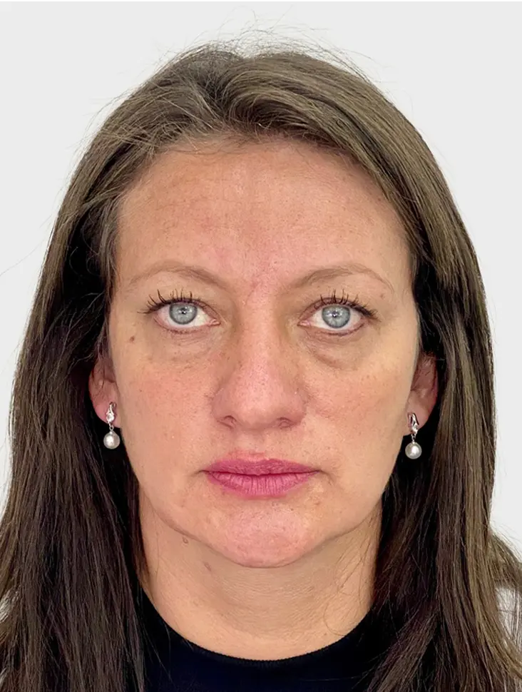 Blefaroplastia - Antes
