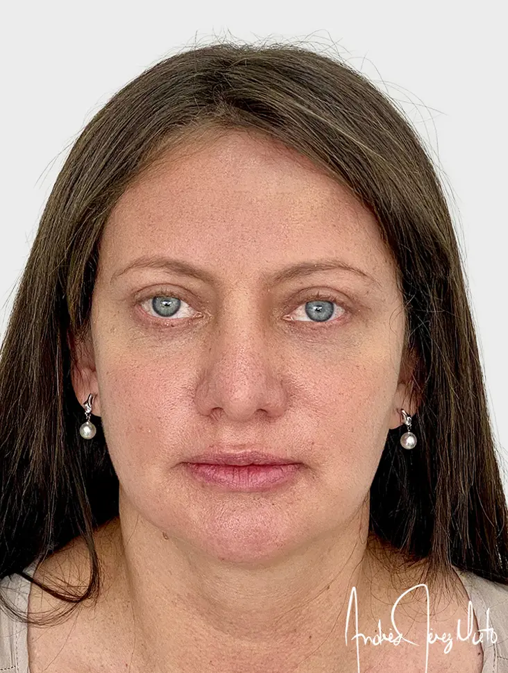 Blefaroplastia - Después