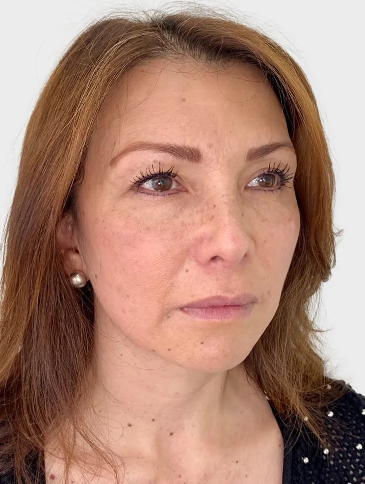 Elevación de cejas - Antes
