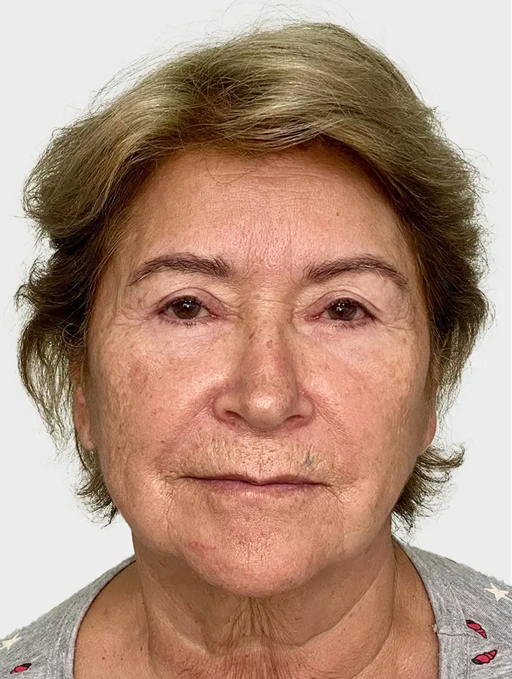 Lip Lift - Antes